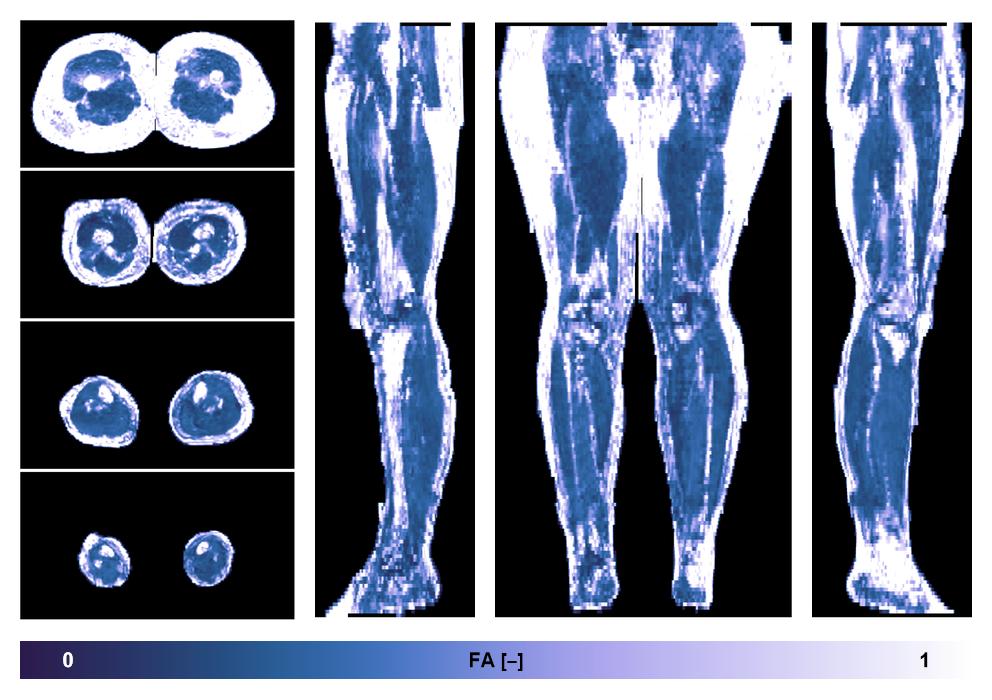 IVIM corrected whole leg muscle fractional anisotropy obtained from diffusion tensor imaging.